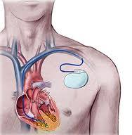 Stanno per realizzare un «Pacemaker biologico» che funzionerà all'interno del cuore