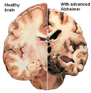 Uno studio rivela l'Alzheimer 20 anni prima dell'inizio dei sintomi