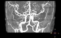 Ultrasuoni per colpire il tumore, è la nuova risonanza magnetica che potrebbe rivoluzionare diagnosi e cure